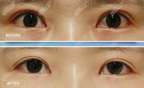 韩国righthand整形外科眼部整形案例