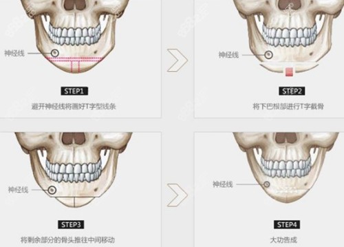 T字截骨手术过程