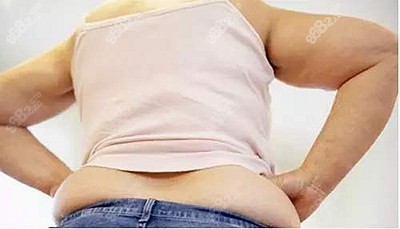 腰腹脂肪堆积可以做吸脂手术