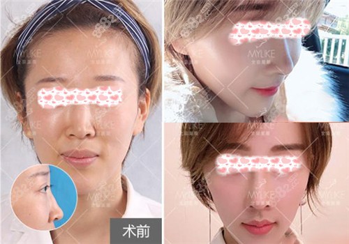 北京美莱医疗美容医院王旭东院长鼻综合手术对比照