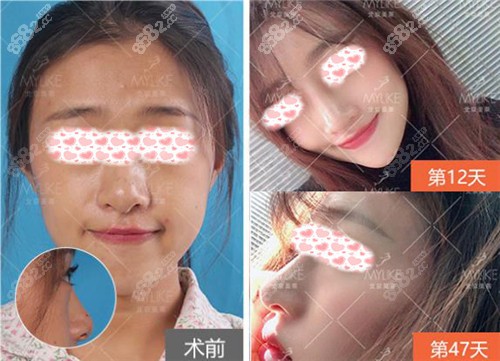 北京美莱医疗美容医院王旭东院长肋软骨鼻部多项案例