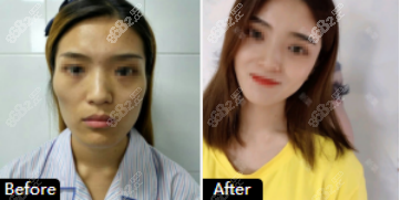 泰安韩美面部自体脂肪填充案例一