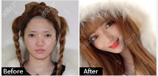 泰安韩美面部自体脂肪填充案例三