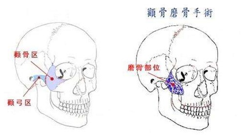 颧骨整形手术的原理图