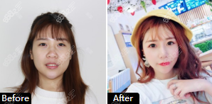 泰安韩美面部自体脂肪填充案例二