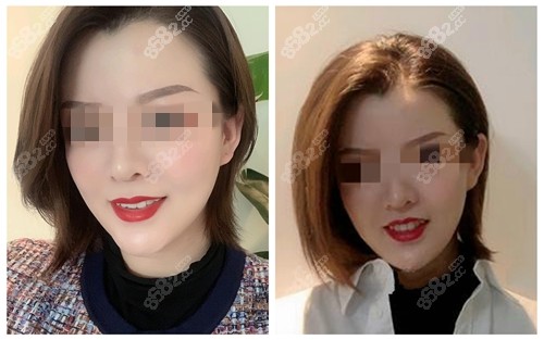 北京艺美王东面部吸脂术后三个月