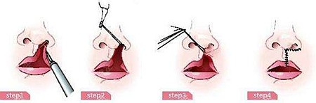 唇腭裂修复的过程