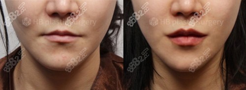 韩国HB整形医院唇部整形前后对比照