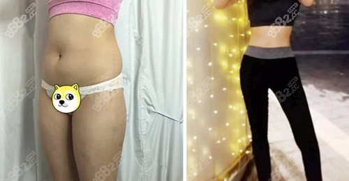 腰腹和大腿吸脂案例