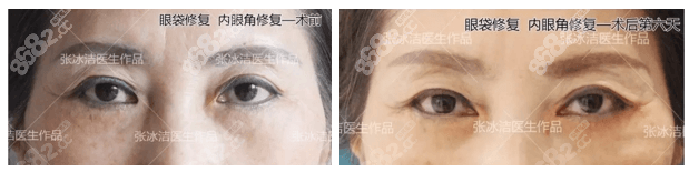张冰洁修复怎么样了？眼袋修复和内眼角修复案例参考