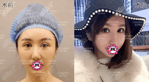 北京克莱美舍张冰洁双眼皮修复+内眼角修复案例