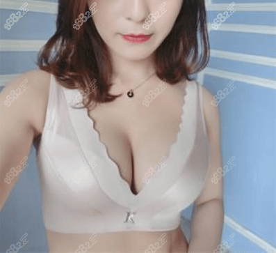 北京画美赵宏伟隆胸技术怎么样?分享花6万多做假体隆胸效果