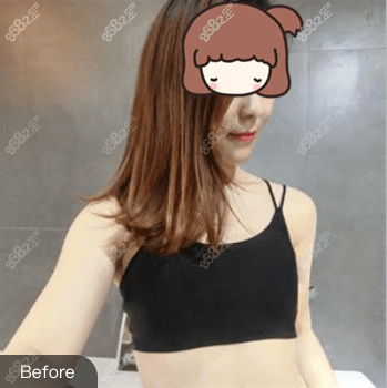 找北京画美赵宏伟做假体隆胸前