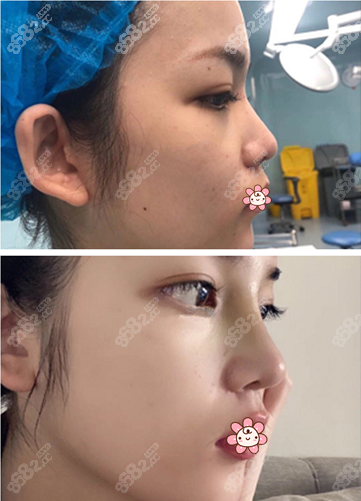 西安艺星整形黄凯隆鼻好不好