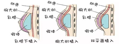 假体丰胸的手术示意图