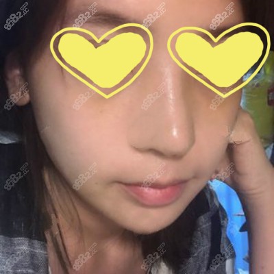 找<!--<i data=20240705-sp></i>-->医生做肋骨鼻综合术后半个月效果