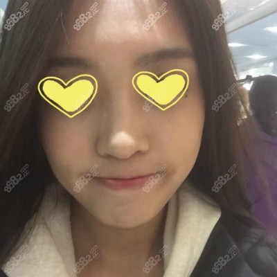找<!--<i data=20240705-sp></i>-->博士做半肋骨隆鼻术前照片
