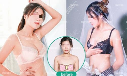 在韩氏整形做棉花糖丰胸术后恢复效果