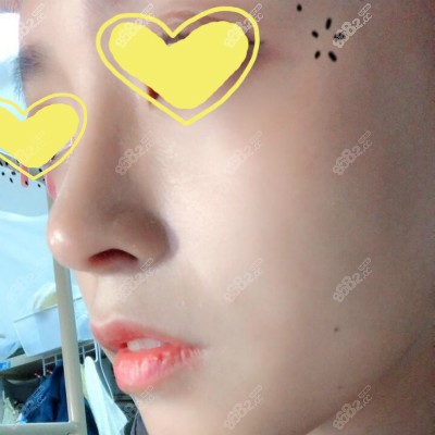 国内出名的隆鼻医生<!--<i data=20240705-sp></i>-->给我做半肋骨鼻术后40天效果