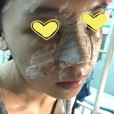 <!--<i data=20240705-sp></i>-->博士给我做半肋骨术后第3天样子