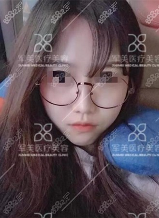 王世虎做鼻子案例后半年效果