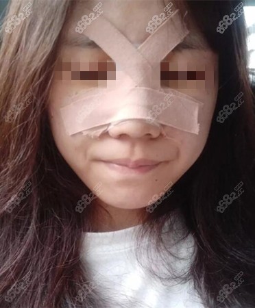 做完鼻综合手术后恢复期