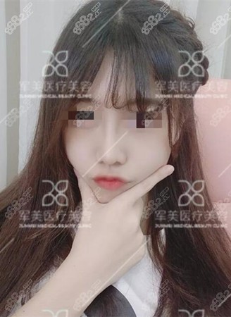 鼻综合手术后2个月恢复效果