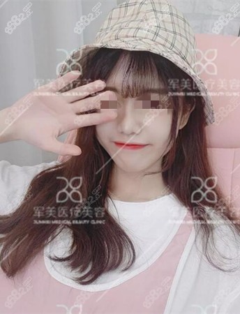 鼻综合手术后2个月