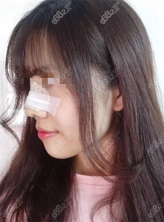 做完鼻综合手术后10天恢复效果