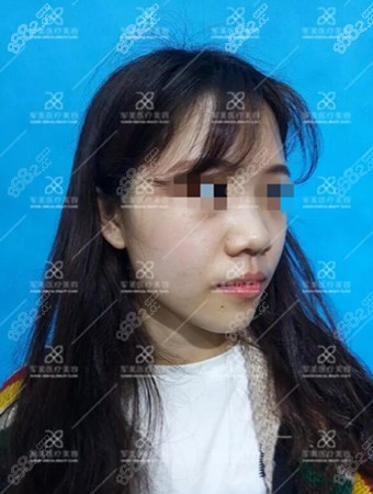 做鼻子手术前