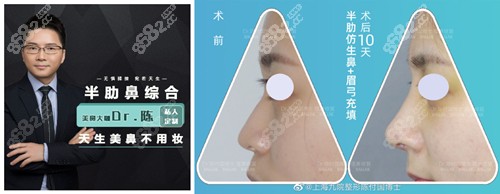 隆鼻案例