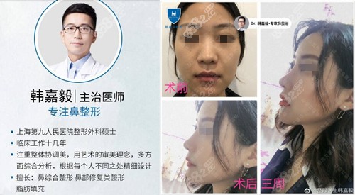 隆鼻案例