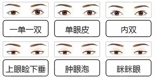 需要做双眼皮的情况