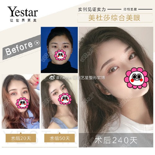 昆明艺星美杜莎双眼皮<span style=