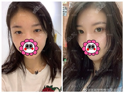 昆明梦想双眼皮前后对比图