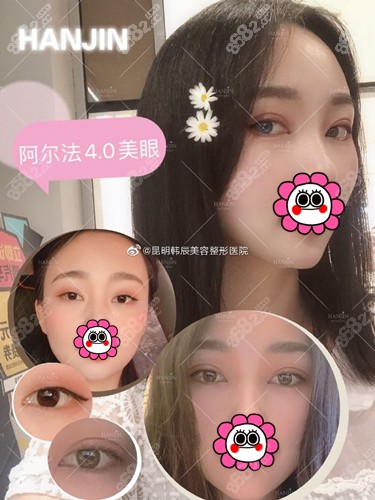 昆明韩辰双眼皮真人<span style=