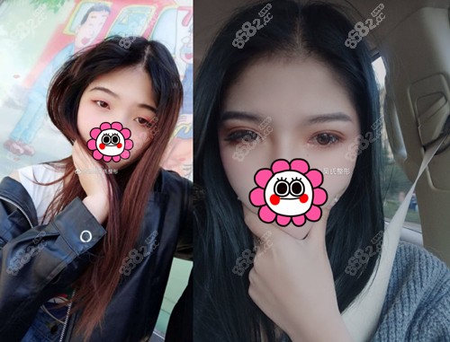 云南吴氏嘉美双眼皮<span style=