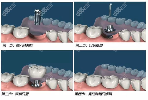 种植牙手术过程