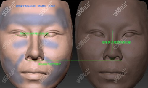 3D模拟隆鼻<span style=