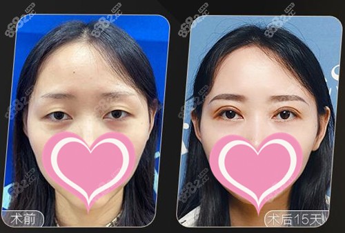 杭州艺星双眼皮修复案例