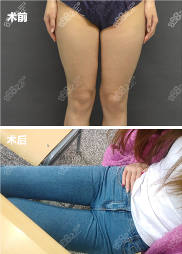 北京润美玉之光大腿抽脂案例