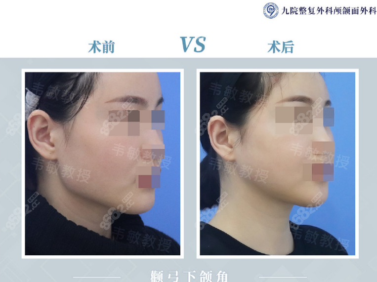 上海九院韦敏颧弓内推+下颌角长曲线截骨<span style=