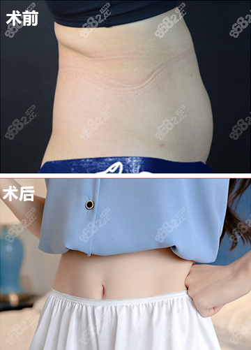 北京禾美嘉腰腹吸脂案例