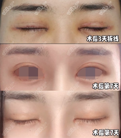 杭州格莱美张霞飞院长双眼皮手术三天和七天疤痕对比
