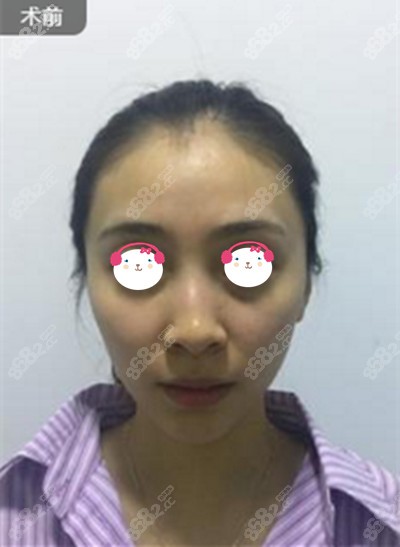 找葛瑾波医生做脂肪填充前