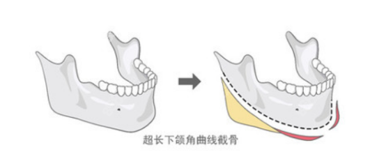 李志海医生做下颌角手术示意图