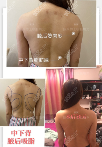 上海哪个医生能做背部吸脂手术