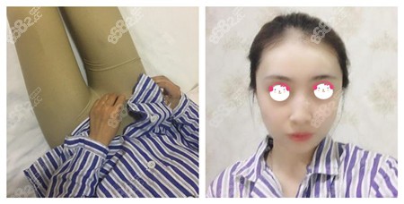 从大腿抽取的脂肪填充到面部