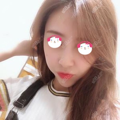 全脸脂肪填充45天后效果很自然