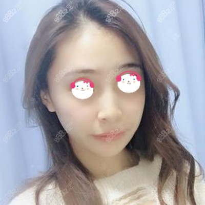 脂肪填充面部15天后的效果